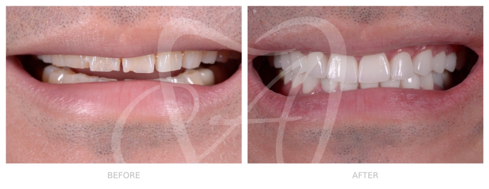 Before and After Dental Transformation 1