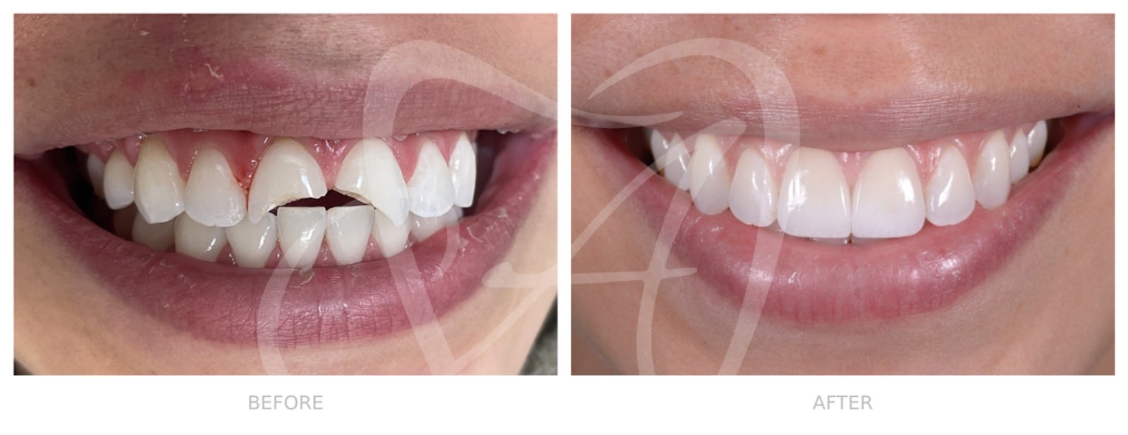 Before and After Dental Transformation 2